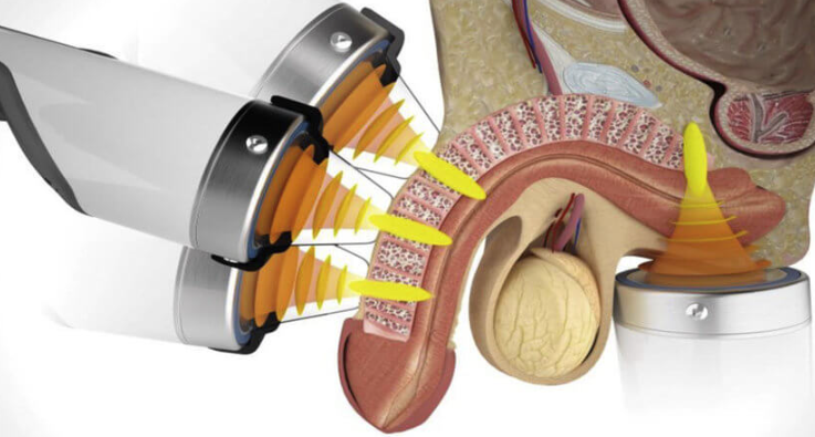 Ağrısız ve İlaçsız Erektil Disfonksiyon Tedavisi: Şok Dalga Tedavisi Nasıl Çalışır?