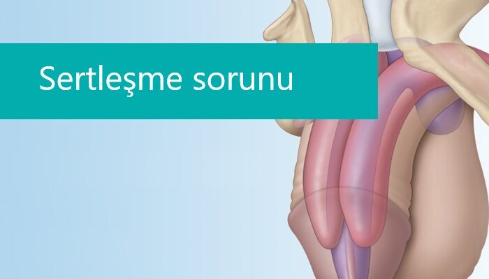 ED1000 ve ESWT Şok Dalga Tedavisi ile Sertleşme Sorunlarına Çözüm